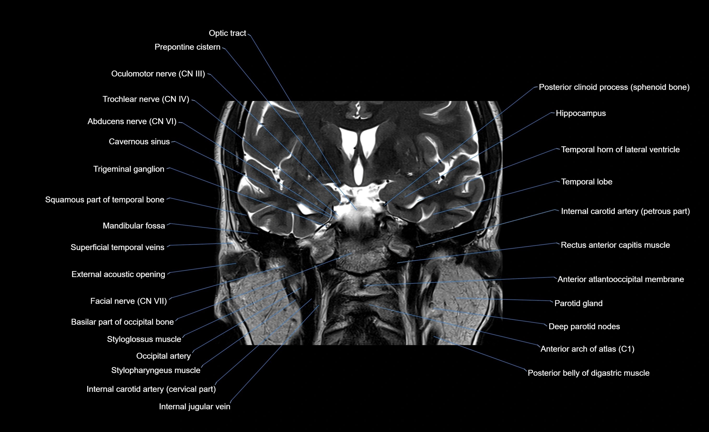 MRI face & paranasal sinuses(PNS) labelled  coronal  cross sectional anatomy 3T radiology  image-img-00001-00039.webp